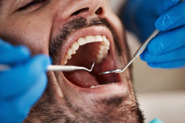 Best Emergency Tooth Extraction in Newton Falls, OH