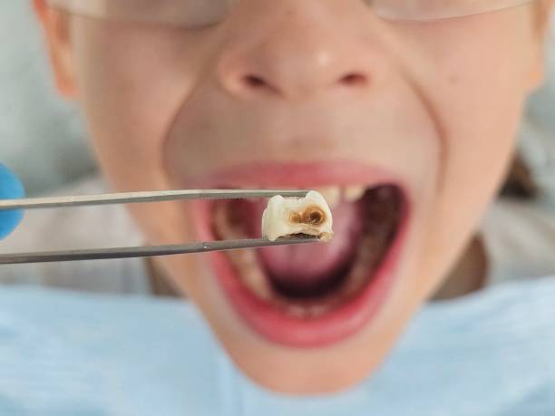 Best Emergency Root Canal Treatment in Newton Falls, OH