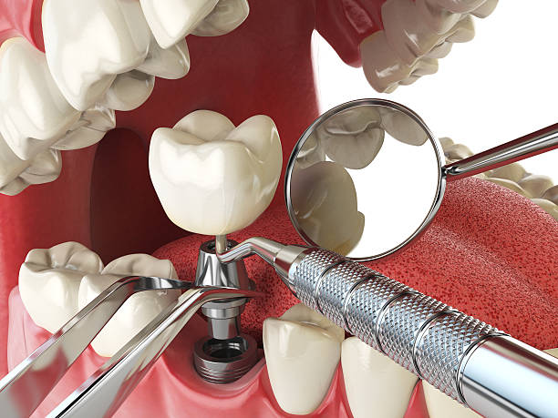 Best Emergency Dental Care for Broken or Chipped Teeth in Newton Falls, OH